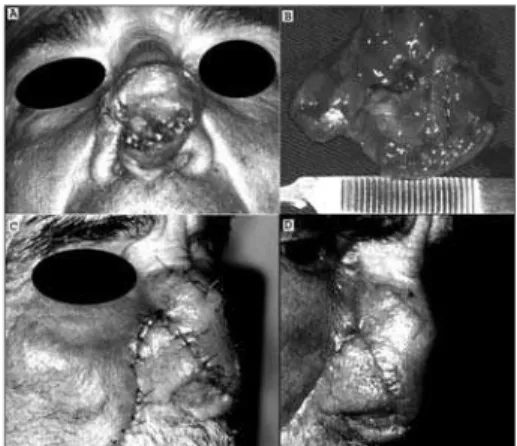 Figura 1. Fotografias demonstrando tricoepitelioma solitário nasal  (A) submetido à exérese cirúrgica (B) e após reconstrução com  retalho nasogeniano (C e D).