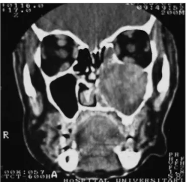 Figure 2. CT coronal slice, soft tissue window.