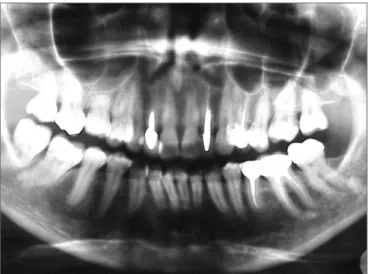 Figure 3A - A-) Panoramic radiograph. This image shows no significant  bone or dental alterations in the area of the lesion (note central and  lateral incisor areas and upper left canines).