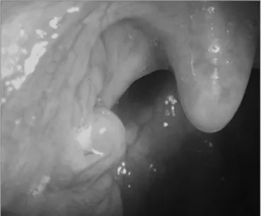Figure 1. Caseum inside a tonsil crypt.