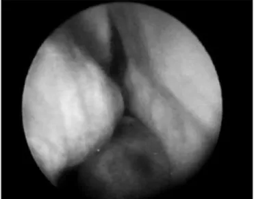 Figure 4 - CT scan - coronal view of a GCCG post operative (case  2).