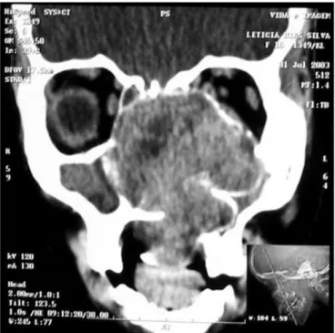 Figure 8 - CT scan - axial view of a relapsed nasosinusal hemangio- hemangio-pericytoma (case 4).