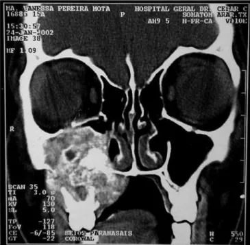 Figure 9 - CT scan - coronal view of a neurofibroma (case 5).