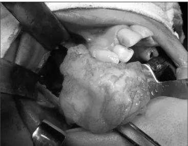 Figure 1. Coronal view CT scan showing a tumor invading the right  maxillary sinus.