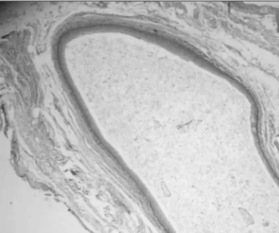 Figura  1.  Cavidade  patológica  revestida  por  epitélio  pavimentoso  estratificado ortoceratinizado, evidenciando ceratina em abundância  no lúmen cístico (Hematoxilina/Eosina, 100x).