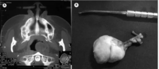 Figura  1.  Fotografia  demonstrando  teratoma  de  nasofaringe  em  tomografia computadorizada (A) e peça operatória (B).