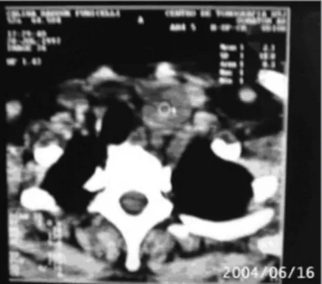 Figure  1.  Computed  tomography  of  the  cervico-thoracic  area  (coronal  slice)  showing  a  tumor  next  to  the  trachea  and the lower pole of the left thyroid lobe.