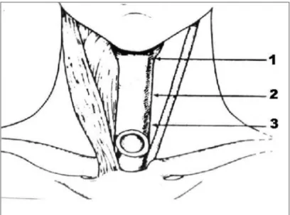 Figure 1. Schematic representation of areas of botulinum toxin injection  on the three thirds of the pharyngoesophageal segment.