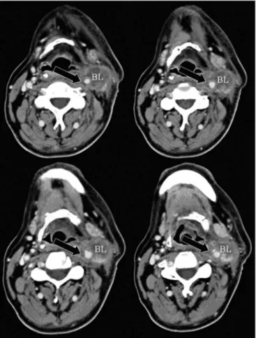 Figure 1 - axial CT with endovenous contrast. Lymphadenomegaly /  high jugular-carotid (level II) lymph node block (BL) to the right with a  contact interface below 50% of the internal carotid artery circumference