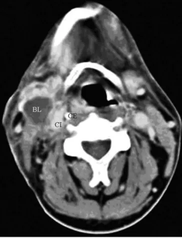 Figure 3 - axial CT (4 sequential sections) with endovenous contrast. 