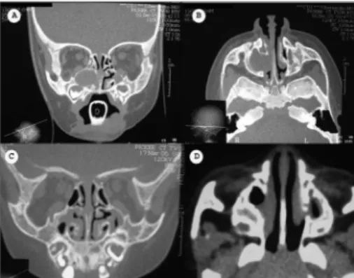Figure 1. Computed tomography of the paranasal sinuses in axial  and coronal sections showing a lesion with soft tissue density in  the right maxillary sinus, bone erosion, and invasion of the  ipsi-lateral nasal cavity (A and B)