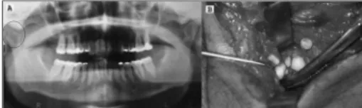 Figura  1. Fotografias  demonstrando  radiografia  panorâmica  da  mandíbula  evidenciando  alteração  (círculo)  da  articulação  têmporo-mandibular direita (A) e remoção cirúrgica da  condro-matose sinovial (B).