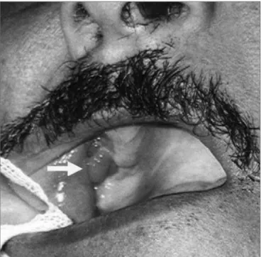 Figure 2. Ample fistula measuring over 1 cm following tooth extrac- extrac-tion.