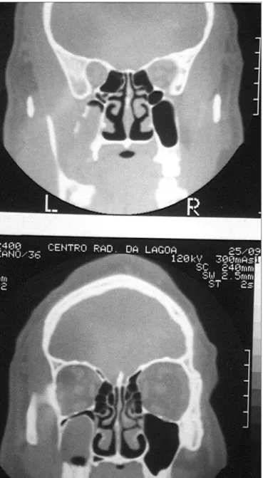 Figure 4. Fistula and an image of a mycetoma in the sinus.