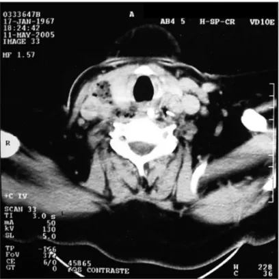 Figure 2. FB coming out in the submandibular region.