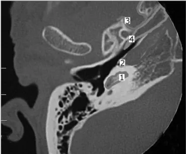 Figure  5.  Foreign  body  in  the  right  Eustachian  Tube,  compared  to  the left tube.