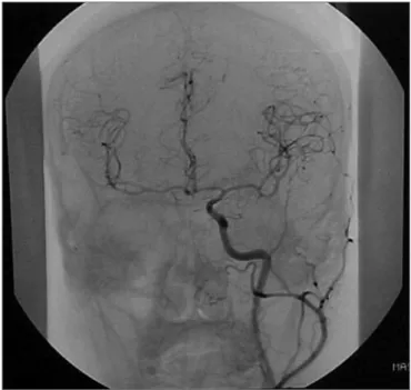 Figure  9.  Coronal  view  with  thrombosis  blocking  the  entire  right  carotid artery.