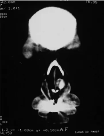 Figure 2. Round nodular lesion, well outlined in the left piriform ope- ope-ning, with soft tissue liope-ning, presenting intense highlight after contrast  injection, with 1.2cm in diameter.