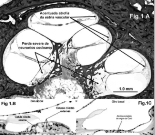 Figura 1A. Vista geral da cóclea evidenciando redução de neurônios  cocleares principalmente no giro basal e acentuada atrofia da estria  vascular em todos giros da cóclea