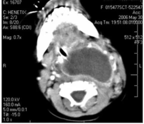 Figure 1. Large retropharyngeal abscess seen in computed  tomography (CT).