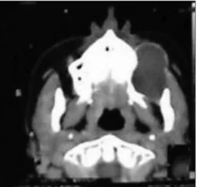 Figure 1. Computed tomography showing an intraosseous cyst  in the left maxilla.