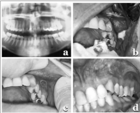 Figure 1. (a) Panoramic X-ray showing a radiolucent, unilocular area,  well outlined, in the region of the canine to the first molar in the right  side, involving the unerupted tooth; (b) Surgical cavity with the cyst,  the ruptured capsule, showing a whit