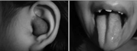 Figura 1. Neurofibroma plexiforme em conduto auditivo e língua.