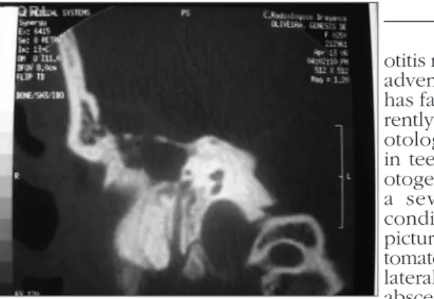 Figure  1. Computed tomography of the right ear (coronal section),  showing erosion of the tegmen tympani.