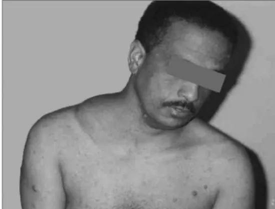 Figure 1. Neck Schwannoma.