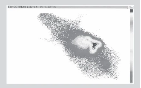 FIGURE 7 - Static imaging of  99m Tc-octreotide at 15 min post-injection.