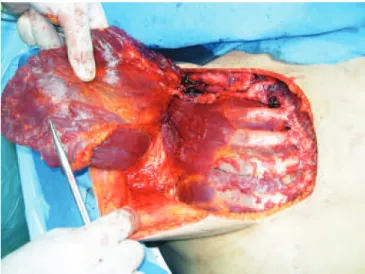 Figure 3 – Anatomical dissection of the nose with  exposure of the cartilage.