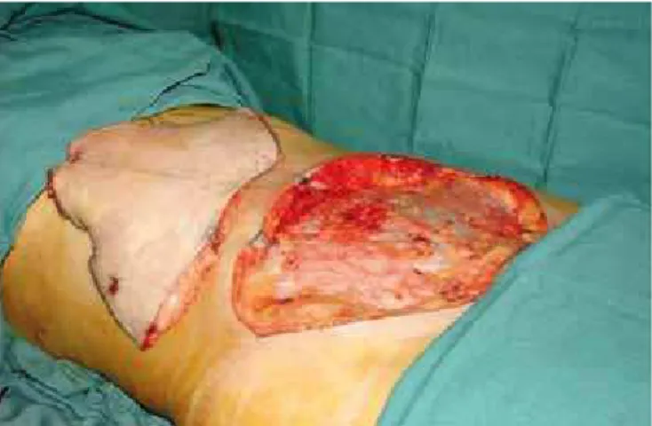 Figure 2 – Prior resection: infraumbilical lap resected in a single  block prior to supraumbilical detachment.