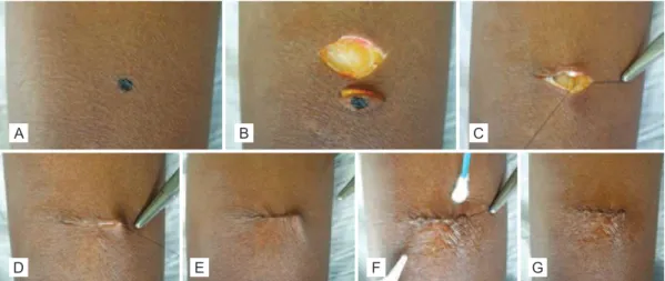 Figure 1 – Surgical technique in the case group. A) Nevus in the lateral aspect of the left arm