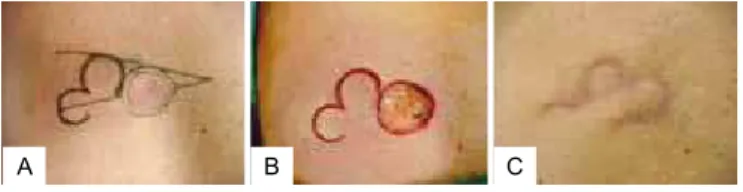 Figure 1 – Marking of Meadows et al.16 In A, basal cell carcinoma  of the patients back and lap design