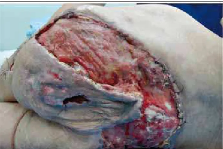 Figure 10 – Recurrence in the eighth month of the postoperative  period.