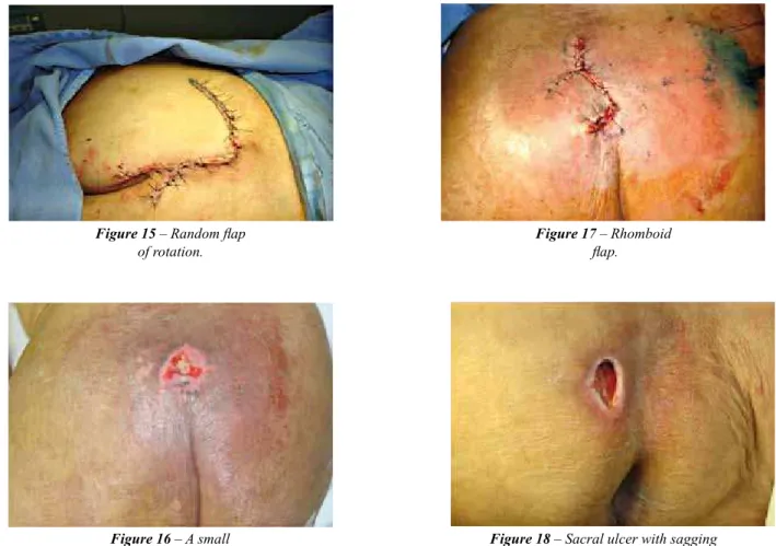 Figure 1 6  – A small  sacral ulcer.