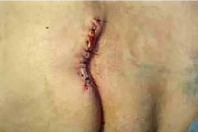Figure 21  – Posterior lap of the  thigh in V-Y.