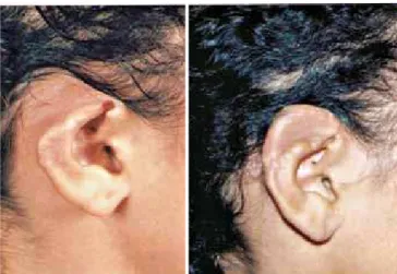 Figure 1 – Pre- and postoperative periods of reconstruction of the  upper pole of the right ear after traumatic injury.