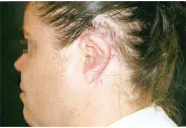 Figure 5 – Preoperative period of a patient with traumatic  loss of the rigth ear.