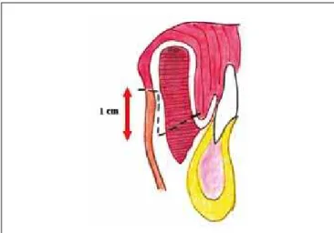 Figure 3 – Schematic drawing of the dissected bilateral  mentolabial skin lap.