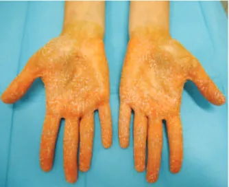 Figure 9 – Result evidencing improvement in hyperhidrosis   8 months after the intradermal injection of type A  