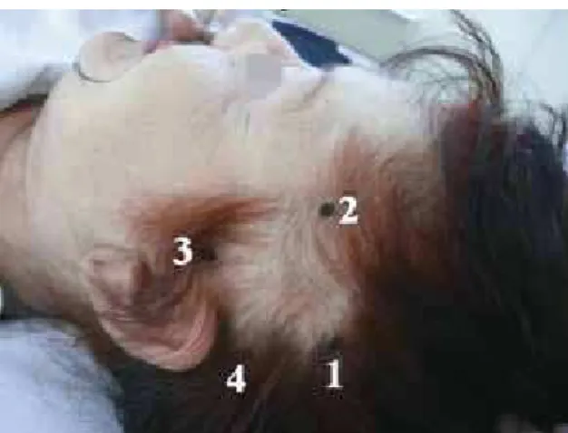 Figure 2 – Reference points in the temporal region,  as described in the text.
