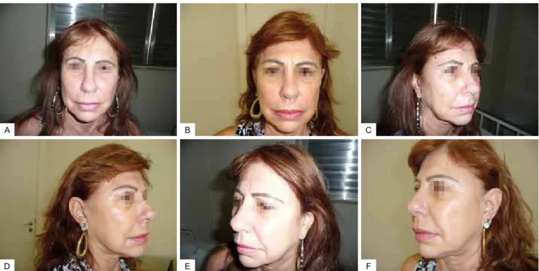 Figure 10  – In  A , front view of a patient before suspension with the thread. In  B , frontal view of a patient three months after  suspension with thread