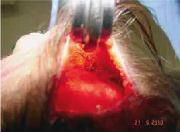 Figure 7 – Closing on two levels: appearance at the end of the surgery.