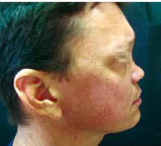 Figure 4 – Case 1. Postoperative period: lateral view.