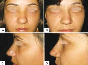 Figure 3 – In A, preoperative period of post trauma rhinoplasty  with the use of polytetraluoroethylene (PTFE) in the nasal 