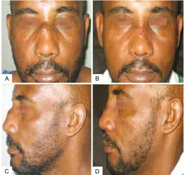 Table 1 – Result assessment according to the aesthetic  improvement achieved with the procedure and the presence or 