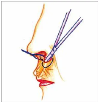 Figure 2 – Detachment of the upper lip skin along its entire length,  with the vermilion mucocutaneous line as a lower limit.