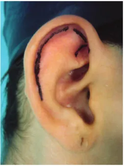 Figure 1 – Anterior marking.