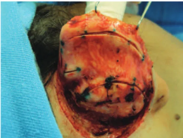 Figure 3 – Resected skin island.